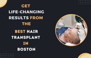 Get Life-Changing Results from the best hair Transplant in Boston